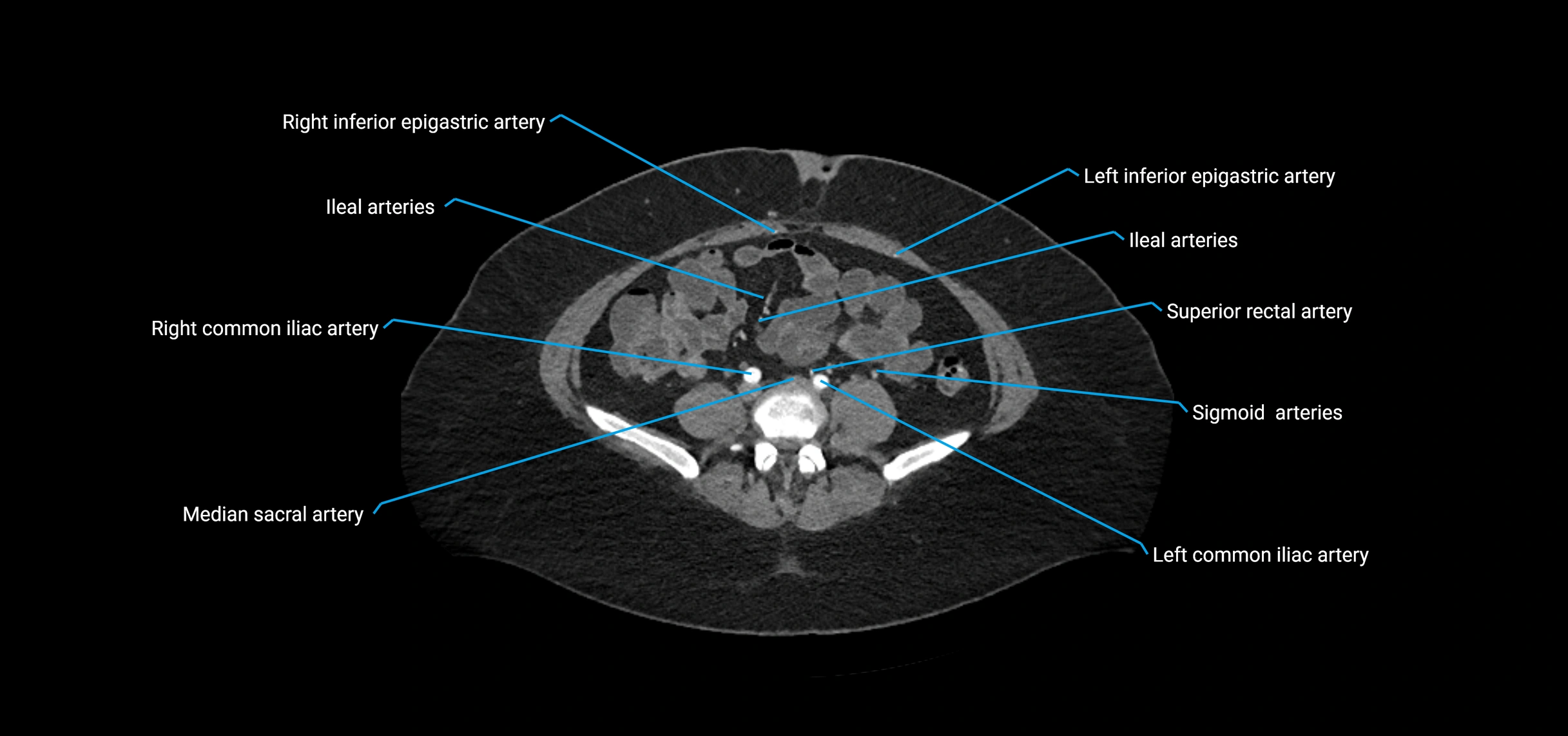 CTA abdomen axial cross sectional anatomy labelled image_156 (2).webp